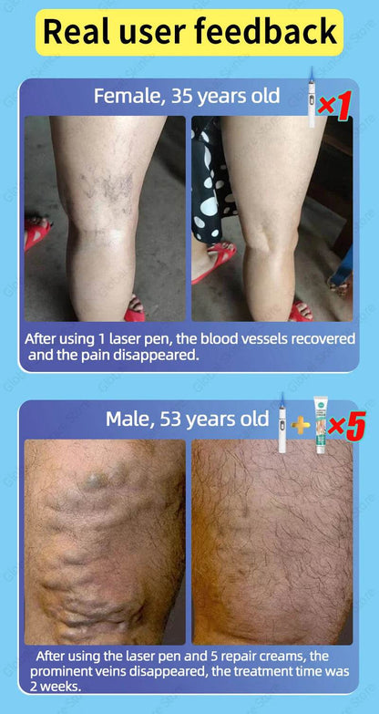 Blue Laser Heals Leg Veins - FLORANZANI- Beauté & Santé