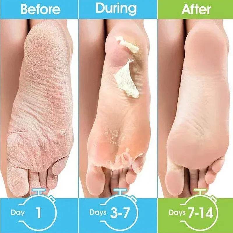 1 Pag = 1 Pair Honey Foot Mask For Remove Dead Skin Calluses Exfoliating Foot Mask Feet Cream Whitening Foot Spa Skin Care Tool - FLORANZANI- Beauté & Santé