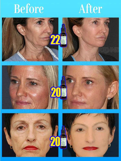 wrinkles disappear 100% younger - FLORANZANI- Beauté & Santé