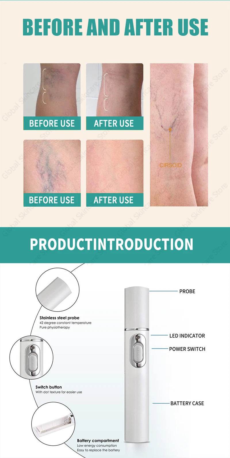 Blue Laser Heals Leg Veins - FLORANZANI- Beauté & Santé