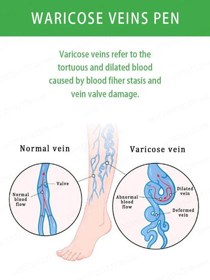 Laser pen removes varicose veins - FLORANZANI- Beauté & Santé