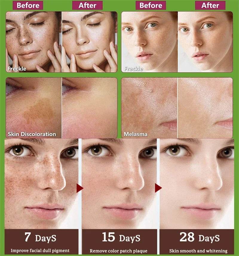 Effective Whitening Serum Remove Dark Spots Freckle Essence Anti-Aging Fade Pigmentation Melasma Brighten Beauty Face Skin Care - FLORANZANI- Beauté & Santé