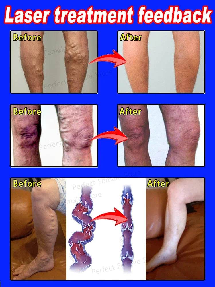 Varicose Veins Products - FLORANZANI- Beauté & Santé