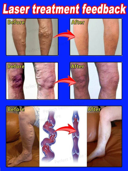 Varicose Veins Products - FLORANZANI- Beauté & Santé