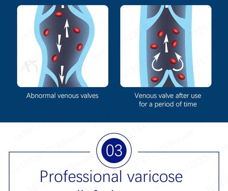 Laser pen removes varicose veins - FLORANZANI- Beauté & Santé