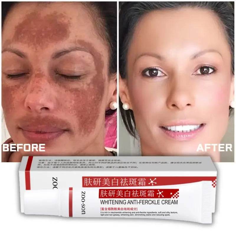 Powerful Spot-removing Whiten Cream Brighten Skin Fast Eliminates Melanin Pigmentation Melasma Dark Spots Korean Skin Care - FLORANZANI- Beauté & Santé