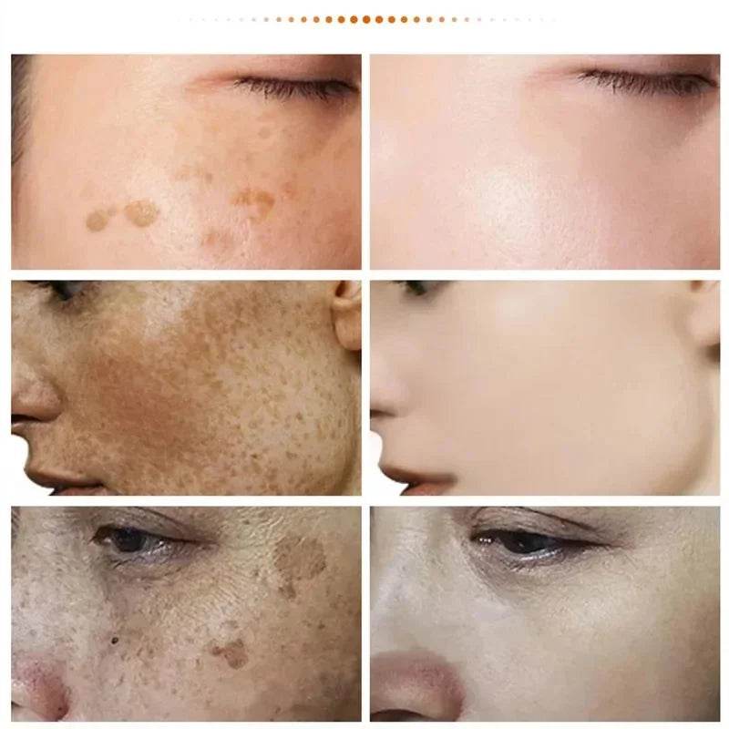 Freckle Removing Cream Women Face Quick Dark Spots Pigmentation Remove Whitening Cream Fade Melasma Brighten Cream for Dark Skin - FLORANZANI- Beauté & Santé