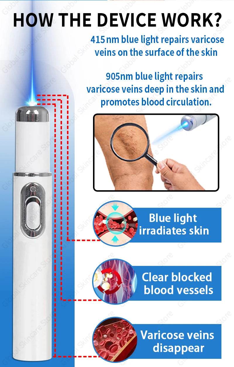 Blue Laser Heals Leg Veins - FLORANZANI- Beauté & Santé