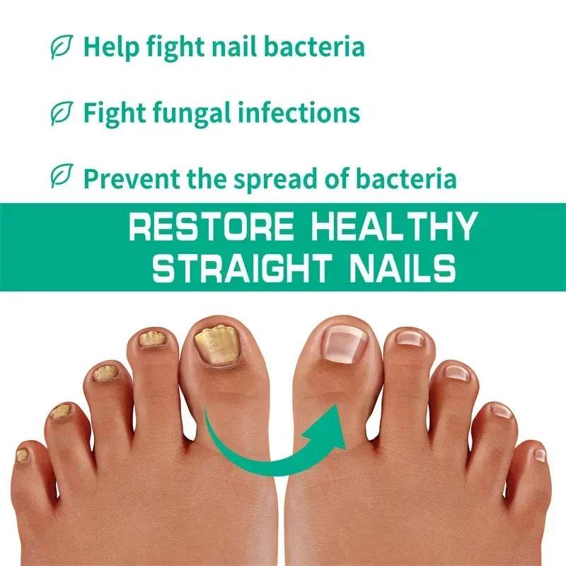 Nail Fungus Treatment Serum Toe Fungal Repair Removal Gel Hand Foot Care Anti Infection Onychomycosis Paronychia Products New - FLORANZANI- Beauté & Santé