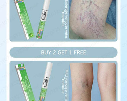 Laser pen removes varicose veins - FLORANZANI- Beauté & Santé