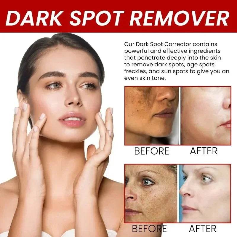 Powerful Spot-removing Whiten Cream Brighten Skin Fast Eliminates Melanin Pigmentation Melasma Dark Spots Korean Skin Care - FLORANZANI- Beauté & Santé