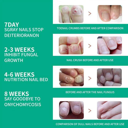 Strong Nail Fungus Treatment Serum Essence Feet Removal Anti Toe Essence Serum Fungal Repa Infection Cream Care Nails J2t0 - FLORANZANI- Beauté & Santé