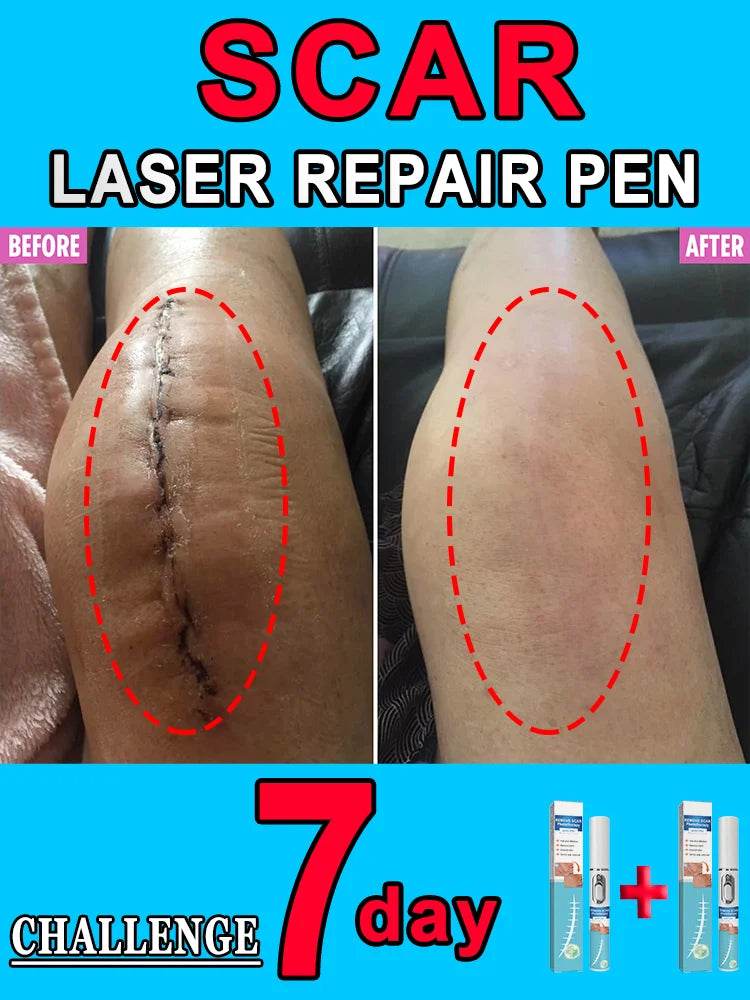 Laser pointer, scars disappear - FLORANZANI- Beauté & Santé