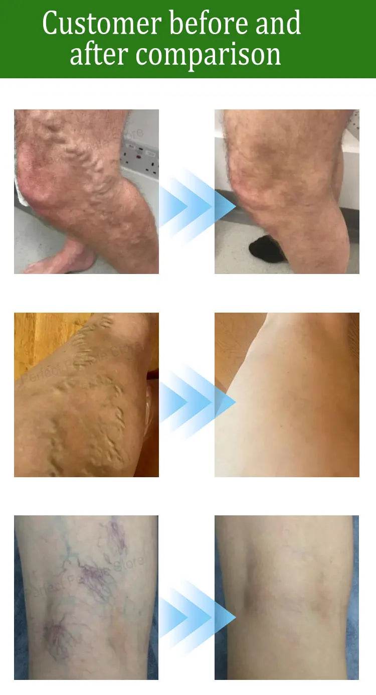 Varicose Veins Products - FLORANZANI- Beauté & Santé