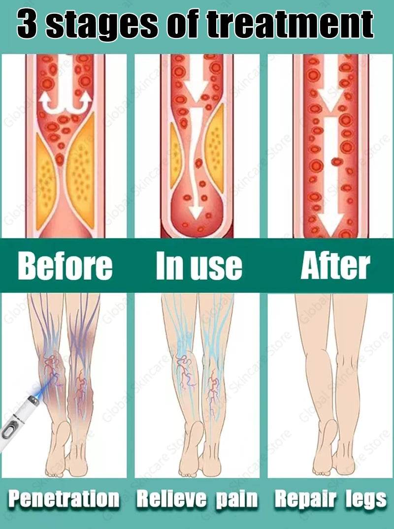 Blue Laser Heals Leg Veins - FLORANZANI- Beauté & Santé