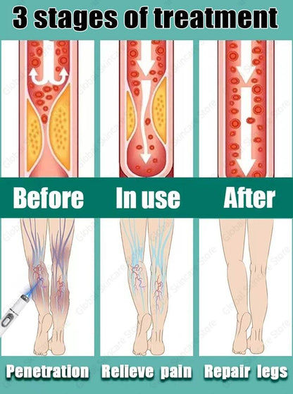 Blue Laser Heals Leg Veins - FLORANZANI- Beauté & Santé