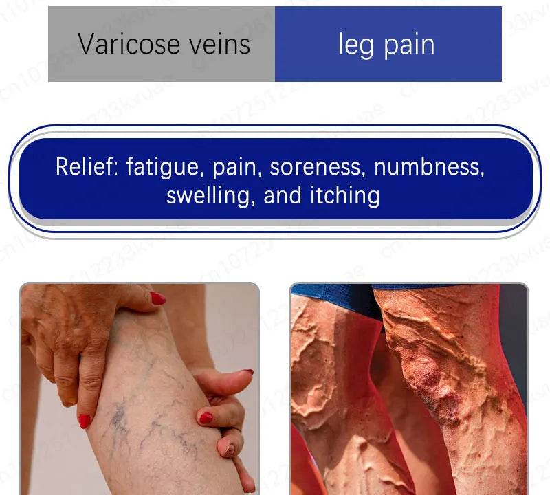 Laser pen removes varicose veins - FLORANZANI- Beauté & Santé