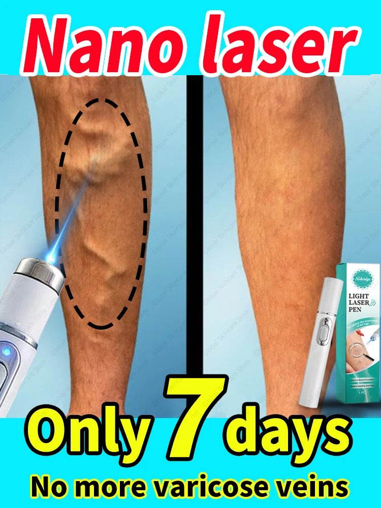 Blue Laser Heals Leg Veins - FLORANZANI- Beauté & Santé