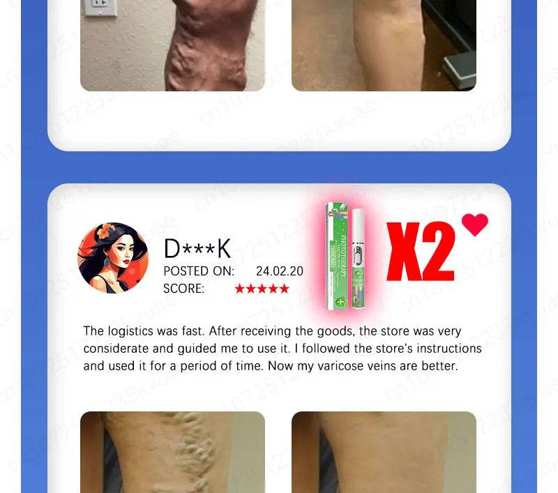 Laser pen removes varicose veins - FLORANZANI- Beauté & Santé