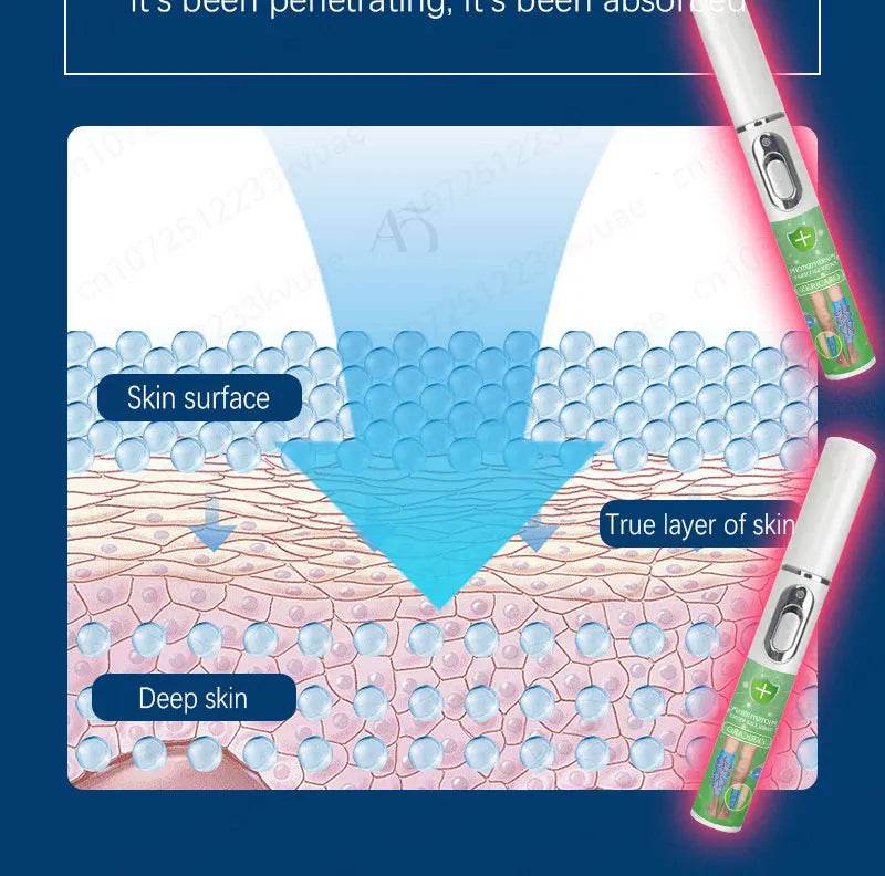 Laser pen removes varicose veins - FLORANZANI- Beauté & Santé