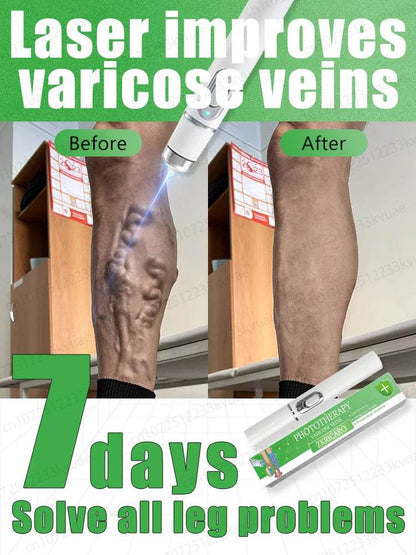 Laser pen removes varicose veins - FLORANZANI- Beauté & Santé