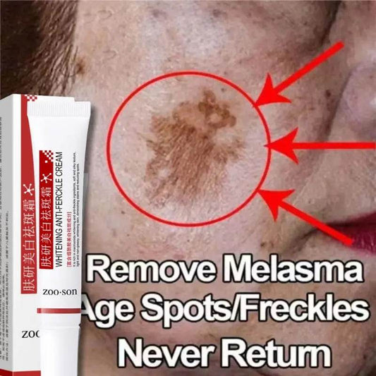 Powerful Spot-removing Whiten Cream Brighten Skin Fast Eliminates Melanin Pigmentation Melasma Dark Spots Korean Skin Care - FLORANZANI- Beauté & Santé