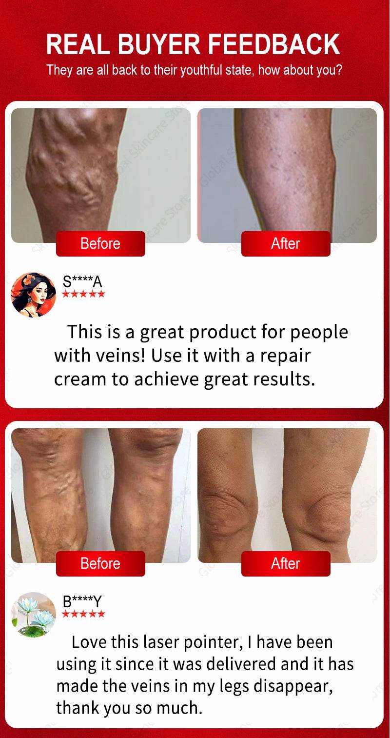 Blue Laser Heals Leg Veins - FLORANZANI- Beauté & Santé