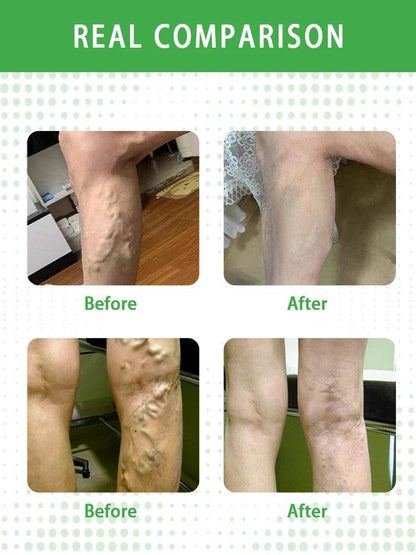 Laser pen removes varicose veins - FLORANZANI- Beauté & Santé