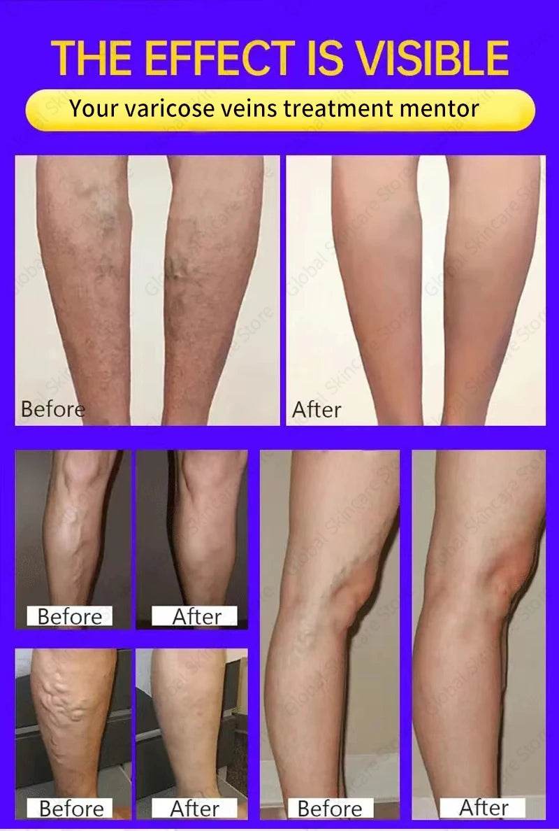 Blue Laser Heals Leg Veins - FLORANZANI- Beauté & Santé