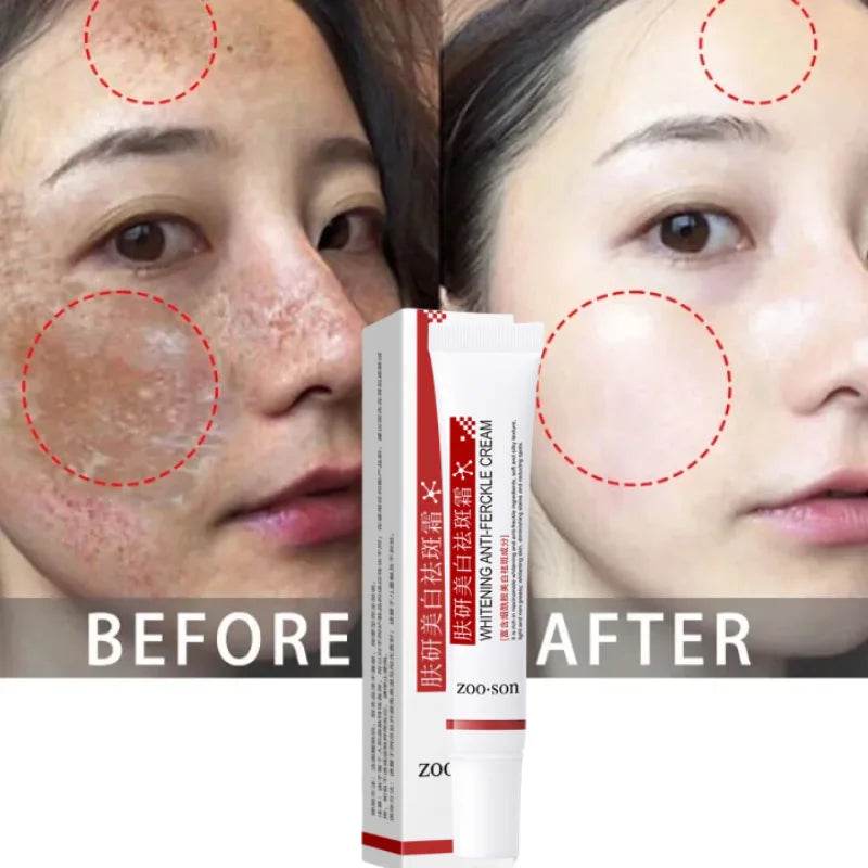 Freckle Removing Cream Women Face Quick Dark Spots Pigmentation Remove Whitening Cream Fade Melasma Brighten Cream for Dark Skin - FLORANZANI- Beauté & Santé