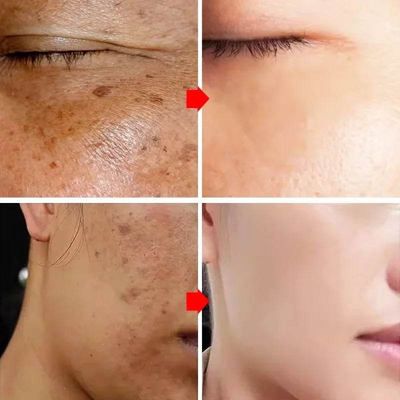 Nicotinamide Whitening Freckles Face Cream Remove Melasma Dark Spots Corrector Fade Melanin Acne Anti-Aging Brighten Skin Care - FLORANZANI- Beauté & Santé