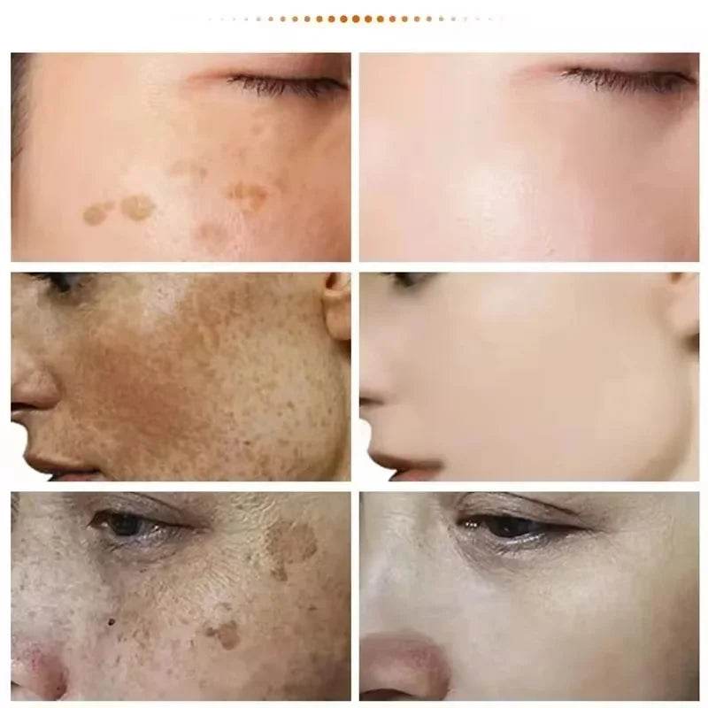 Powerful Spot-removing Whiten Cream Brighten Skin Fast Eliminates Melanin Pigmentation Melasma Dark Spots Korean Skin Care - FLORANZANI- Beauté & Santé