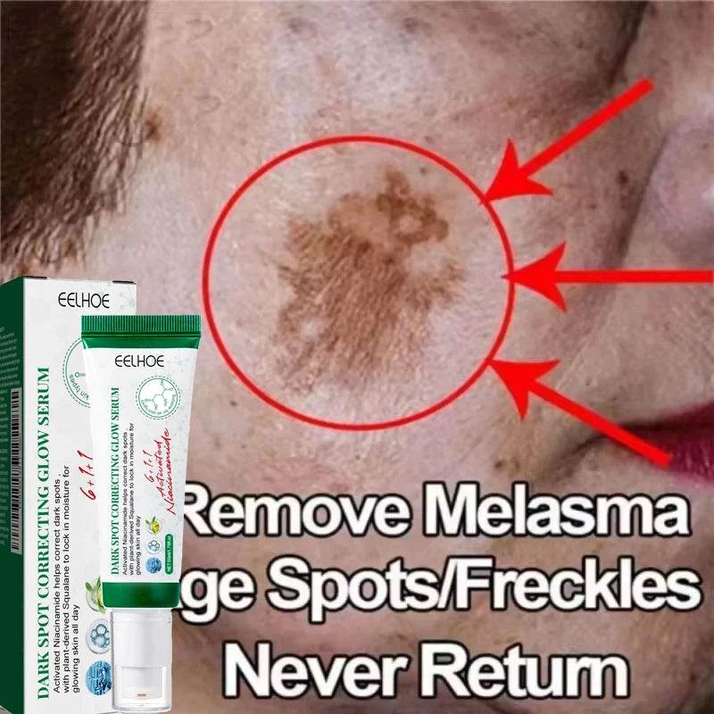 Nicotinamide Whitening Freckles Face Cream Remove Melasma Dark Spots Corrector Fade Melanin Acne Anti-Aging Brighten Skin Care - FLORANZANI- Beauté & Santé