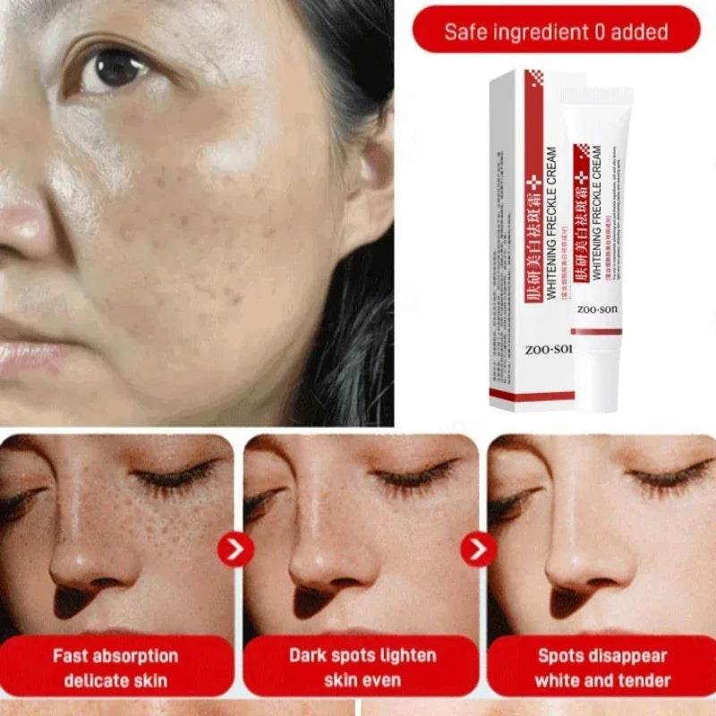 Freckle Removing Cream Women Face Quick Dark Spots Pigmentation Remove Whitening Cream Fade Melasma Brighten Cream for Dark Skin - FLORANZANI- Beauté & Santé