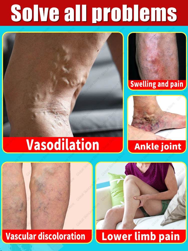 Blue Laser Heals Leg Veins - FLORANZANI- Beauté & Santé