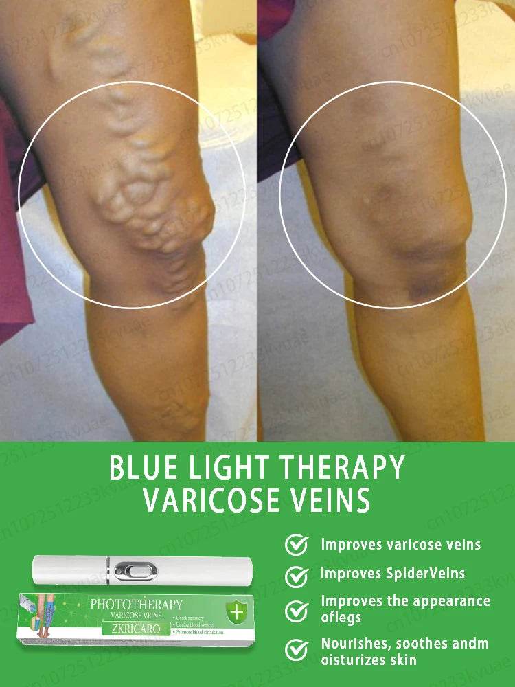 Laser pen removes varicose veins - FLORANZANI- Beauté & Santé