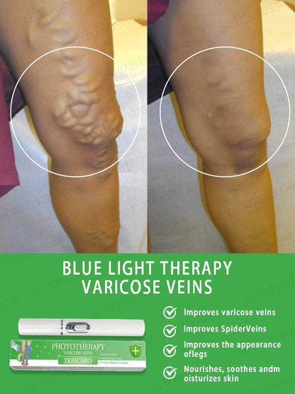 Laser pen removes varicose veins - FLORANZANI- Beauté & Santé