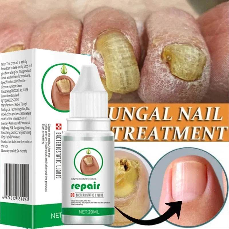 Nail Fungus Treatment Serum Toe Fungal Repair Removal Gel Hand Foot Care Anti Infection Onychomycosis Paronychia Products New - FLORANZANI- Beauté & Santé