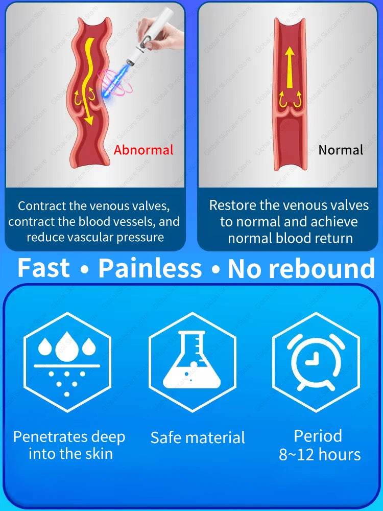 Blue Laser Heals Leg Veins - FLORANZANI- Beauté & Santé