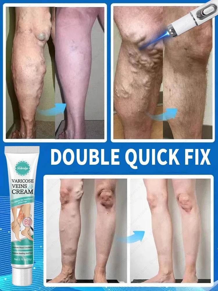 Blue Laser Heals Leg Veins - FLORANZANI- Beauté & Santé