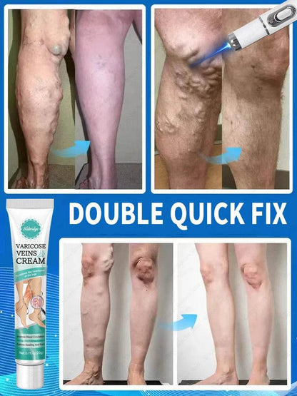 Blue Laser Heals Leg Veins - FLORANZANI- Beauté & Santé