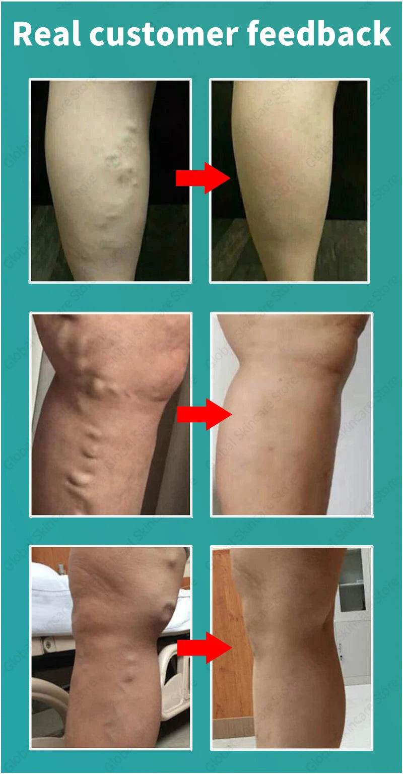 Blue Laser Heals Leg Veins - FLORANZANI- Beauté & Santé