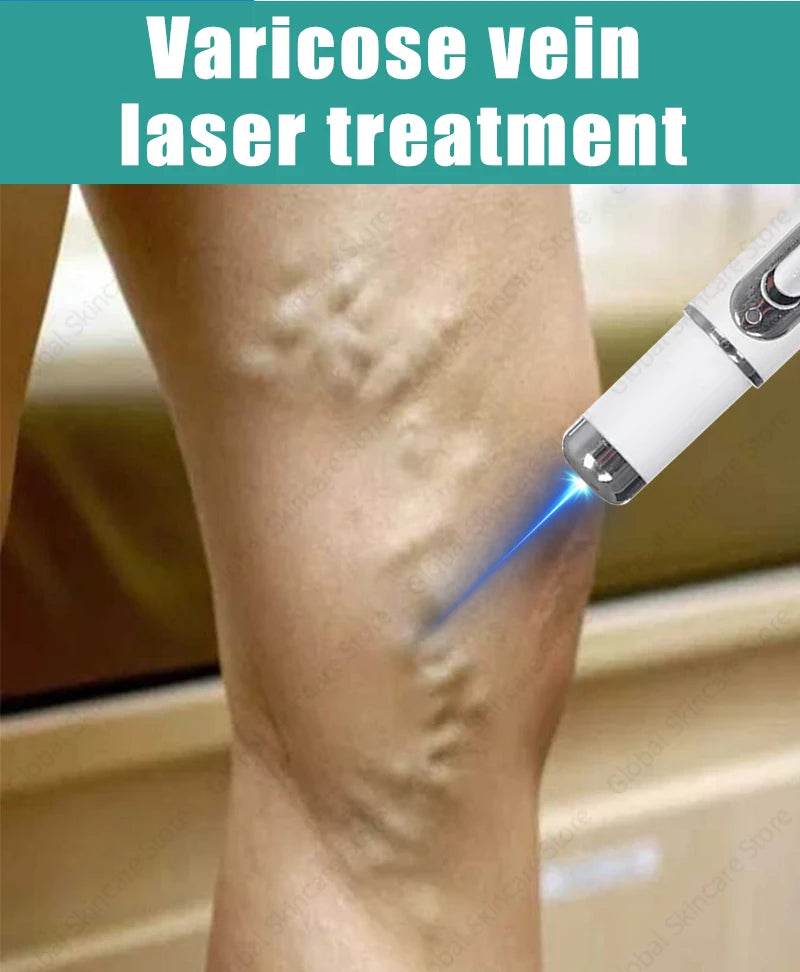 Blue Laser Heals Leg Veins - FLORANZANI- Beauté & Santé