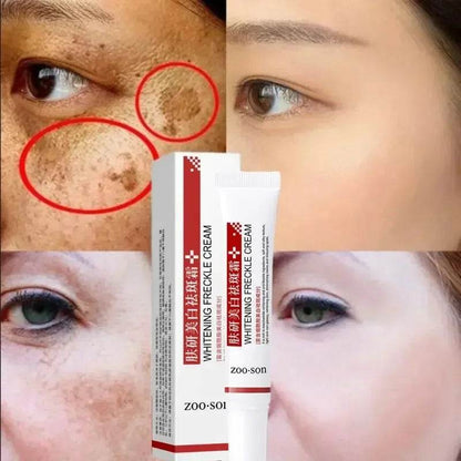 Freckle Removing Cream Women Face Quick Dark Spots Pigmentation Remove Whitening Cream Fade Melasma Brighten Cream for Dark Skin - FLORANZANI- Beauté & Santé