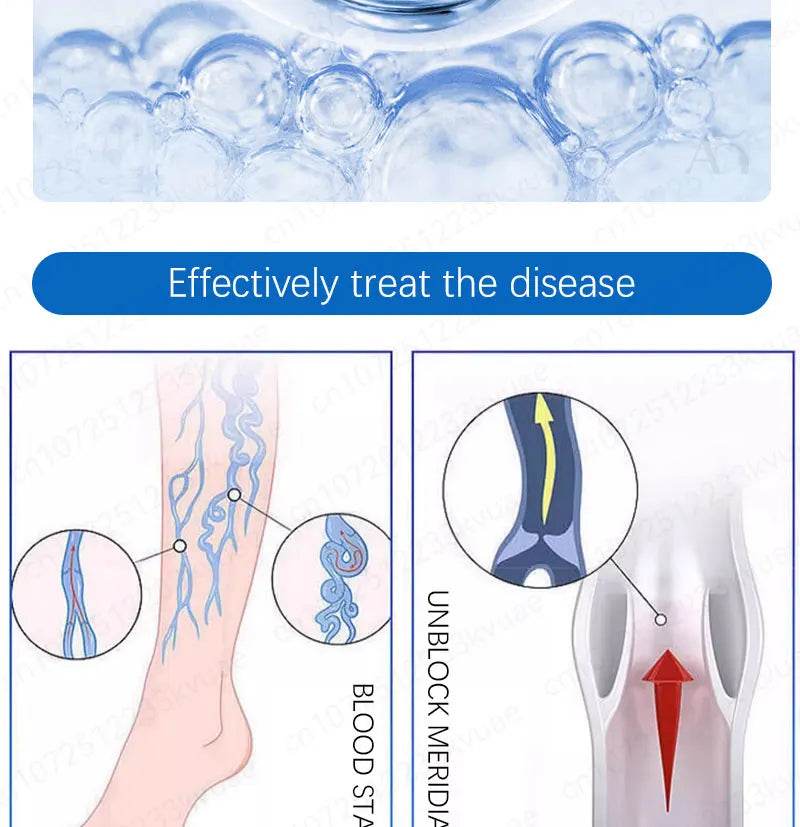 Laser pen removes varicose veins - FLORANZANI- Beauté & Santé