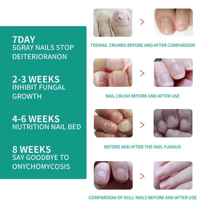 Nail Fungus Treatment Serum Toe Fungal Repair Removal Gel Hand Foot Care Anti Infection Onychomycosis Paronychia Products New - FLORANZANI- Beauté & Santé